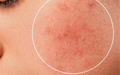 trattamento viso azulene pelle couperose
